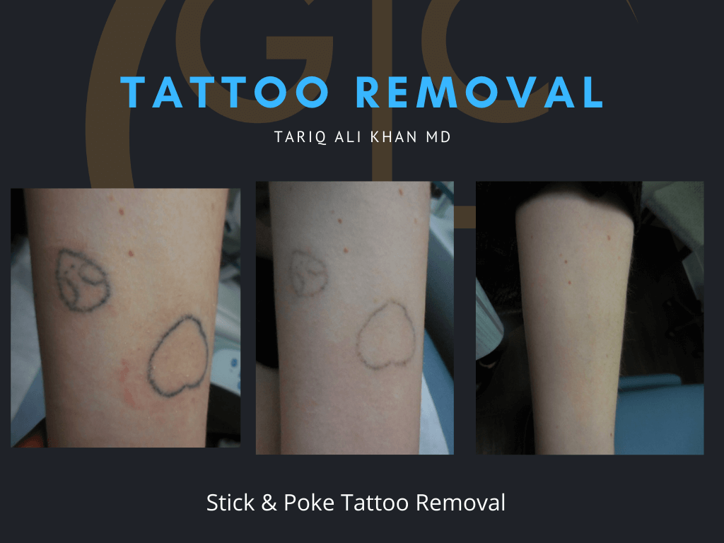 Gentle Care Laser Tustin Before and After picture - Tattoo Removal